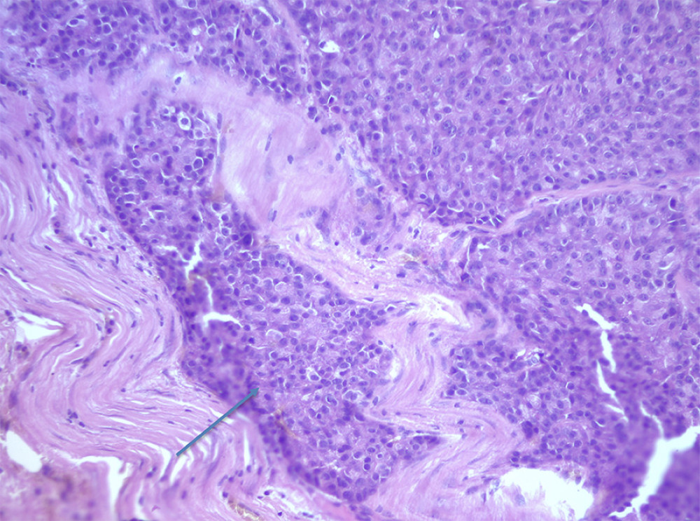 Tumor tissue, hematoxylin and eosin stained specimen (original magnification 200×).