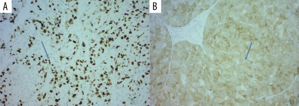 Immunohistochemistry of specimen: (A) proliferation fraction with Ki-67: 75–80% (original magnification 400×); (B) synaptophysin positivity (original magnification 200×).