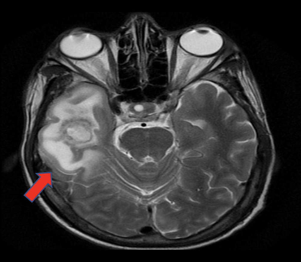 Brain MRI scan report. The red arrow points to a right-sided temporal lobe lesion (abscess). MRI – magnetic resonance imaging.