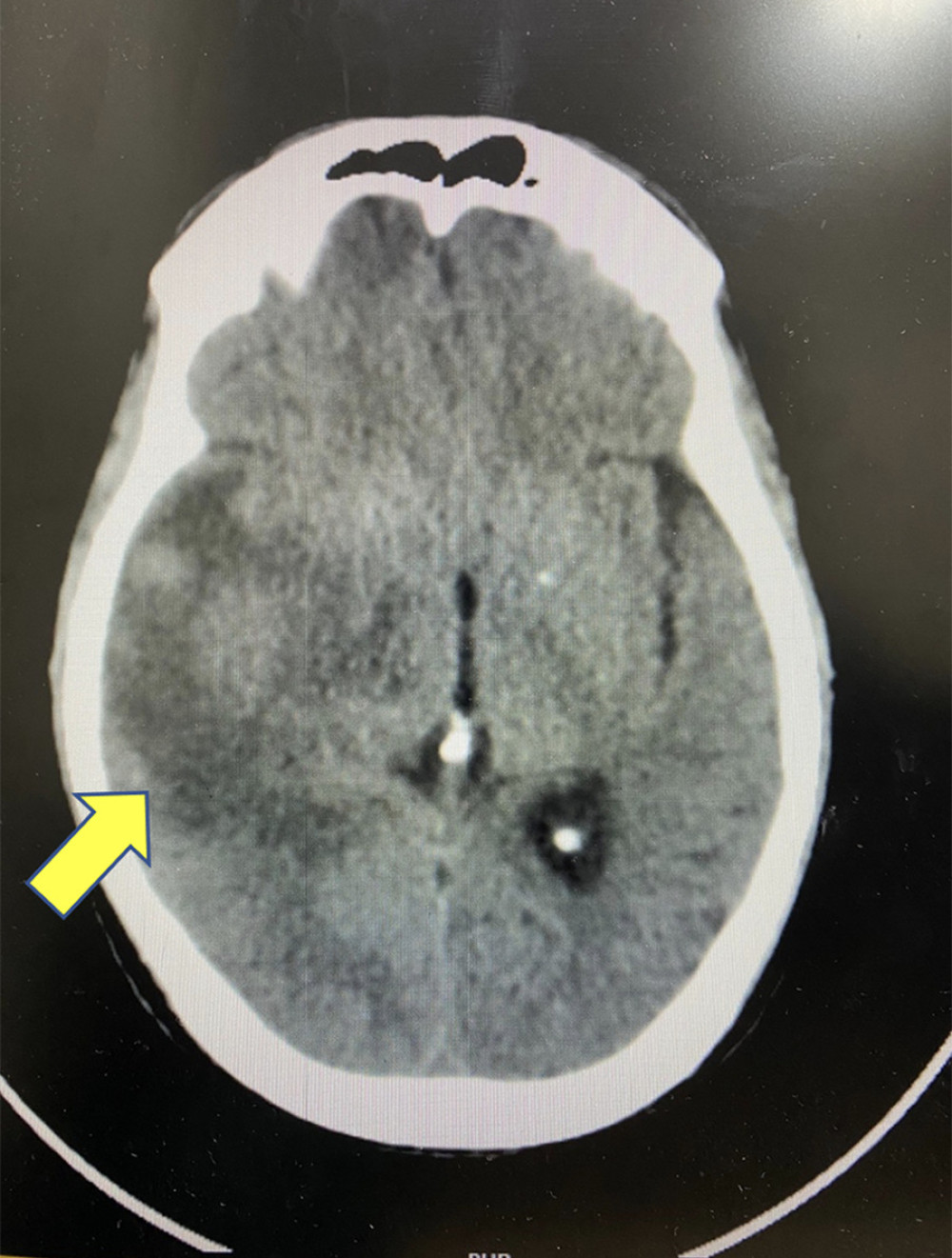 Brain CT scan report. The yellow arrow points to a right temporal lobe lesion. CT – computed tomography.