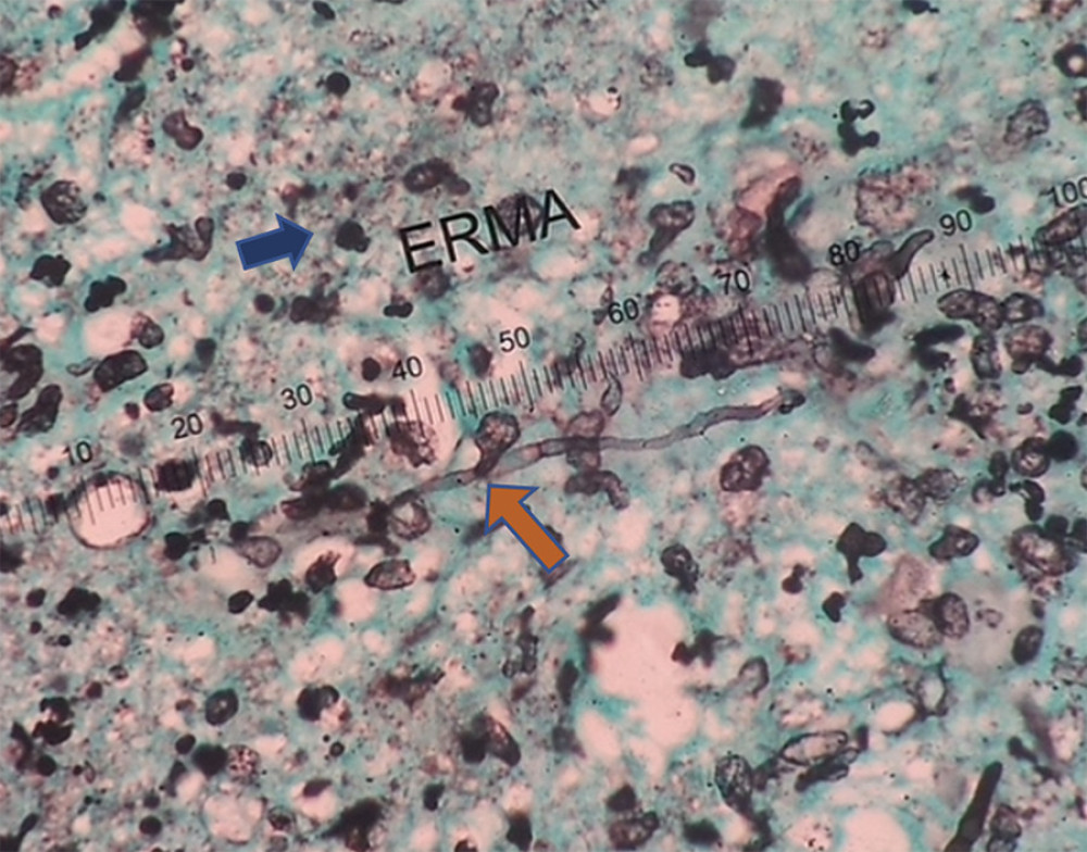 Histopathology slide with GMS staining. The orange arrow points to the hyaline septate filamentous fungus. The blue arrow points to foreign body giant cells in the background with granulation tissue and necrotic cell debris. GMS – Gomori’s methenamine silver.