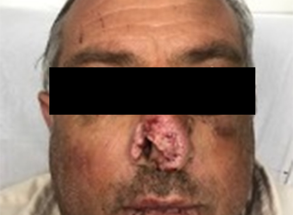 A 58-year-old man with his right nasal ala amputated by a human bite.