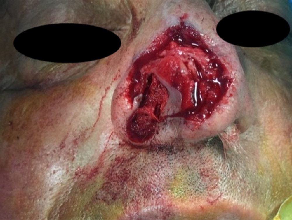 The wound site after debridement of necrotic cartilage and skin.