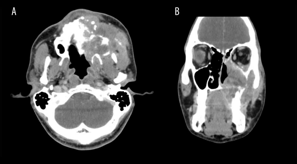 Unenhanced computed tomography scan in (A) axial and (B) coronal plane shows destructive soft tissue mass seen in the left maxillary sinus measuring approximately 5.8×6.6 cm and extended to involve the left nasal cavity, ethmoid air cells, upper alveolar ridge, hard palate, and orbital floor, with intraorbital extraconal infiltration with no ocular involvement.