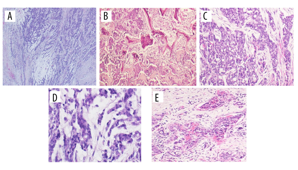 (A) Anastomosing nests of basaloid cells in myxoid stroma. (B) Tumor cells show invasion into surrounding bone. (C) Monotonous proliferation of basaloid cells with prominent cytoplasmic vaculation. (D) Some tumor cells showed rhabdoid features with nuclei pushed to periphery. (E) Lymphovascular invasion.