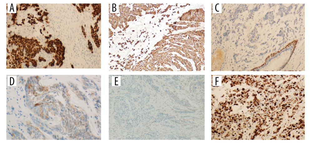 Tumor cell are positive for (A) CK 7, (B) CK AE1/AE3, and negative for (C) P63, (D) Synaptophysin, with loss of SMARCB 1 (INI 1) in tumor cells with the (E) background cells acting as positive internal control. (F) KI-67 shows a high proliferation index.
