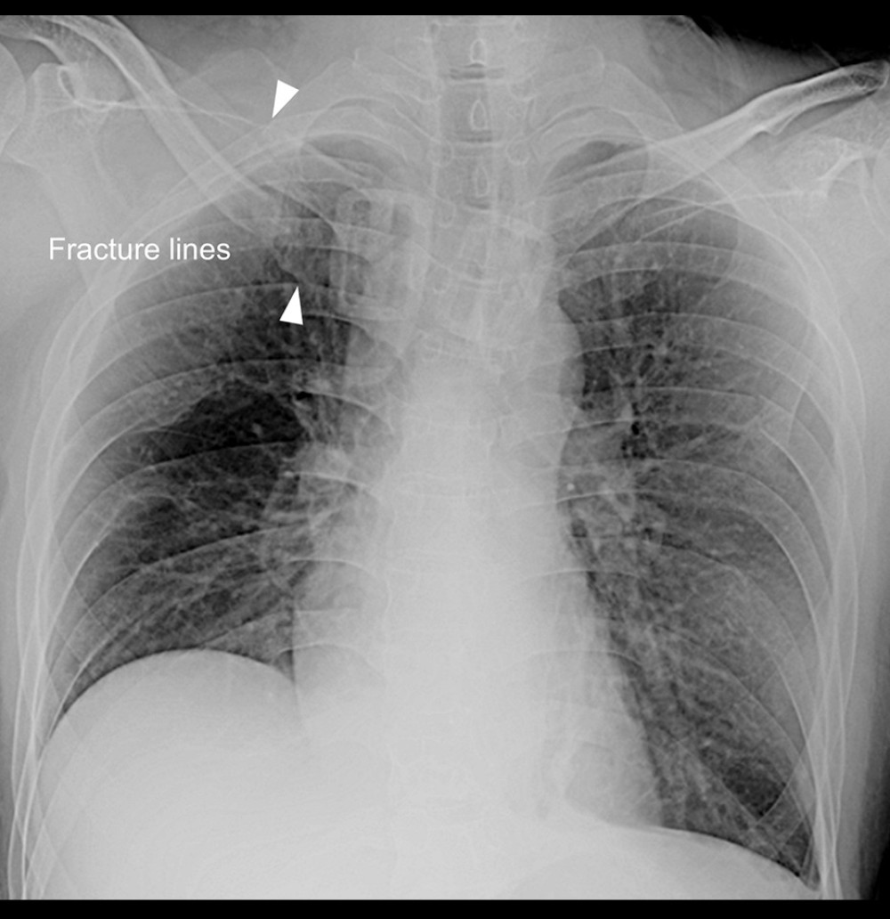 Chest X-ray on arrival. The right clavicle was fractured, and the distal part of the fracture was dislocated to the right thorax (arrow heads show the fractured lines).