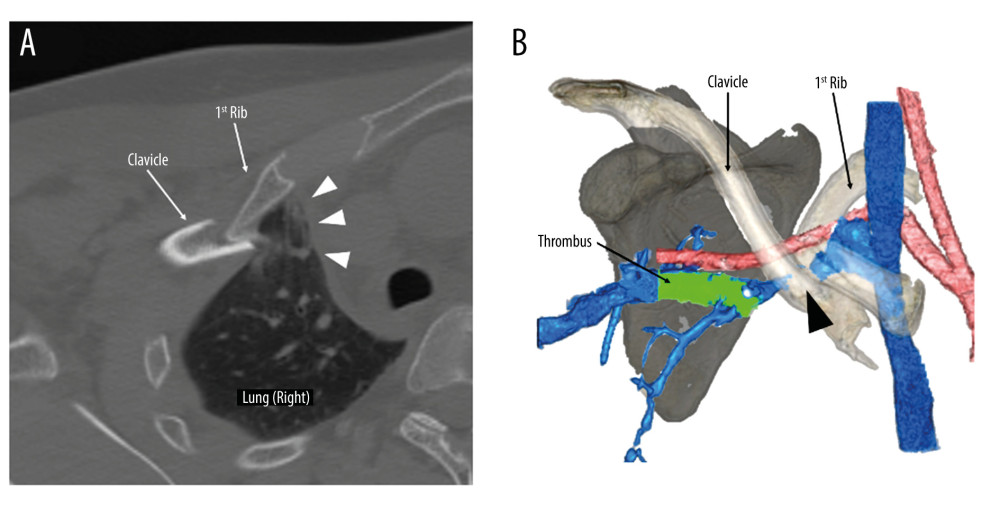 Computed tomography (CT) on arrival. (A) Non-enhanced CT shows the fractured clavicle projecting to the right pleural cavity and pulmonary contusion (white arrow heads). (B) 3D reconstruction image from enhanced CT shows the compression on the subclavian vein (black arrow heads) caused by the displaced fractured clavicle and first rib. A thrombus (light green) is present on the distal side of the compression.