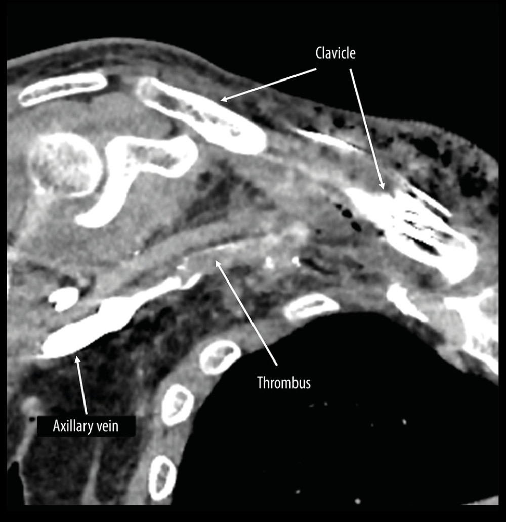 Enhanced computed tomography after clavicle fixation. The thrombus remained in the subclavian vein after the surgical fixation of the clavicle.