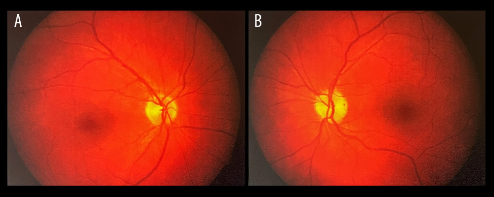 (A, B) Fundus photography of the right asymptomatic and left symptomatic eye of the patient with optic neuritis associated with sphenoid sinusitis revealed a normal fundus in the right eye and slightly elevated with marked borders optic disc in the left eye.