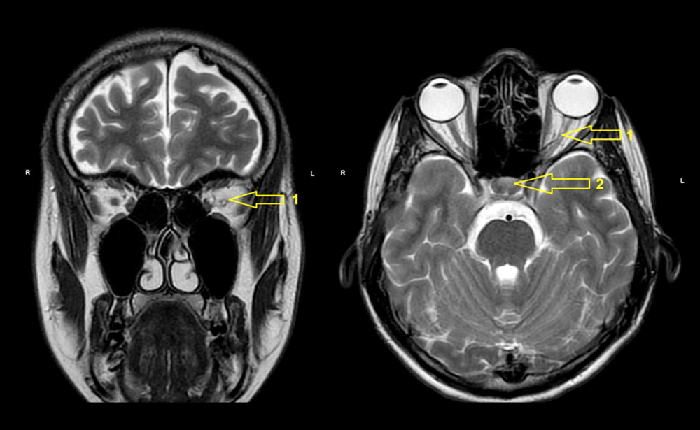 The brain MRI of patient with ON associated with sphenoid sinus disease: a small amount of mucus content in the sphenoid sinus, increased fluid signal in the left optic nerve with a slight reduction in its thickness compared to the right side, possibly chronic demyelinating changes. 1. Increased fluid signal in the left optic nerve in a T2-weighted image with a slight reduction in its thickness compared to the right side. 2. A small amount of mucus content in the sphenoid sinus.