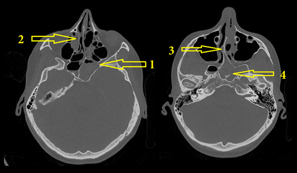 Computed tomography of the head showing a chronic inflammatory infiltrate and a 1–2 mm sinus wall defect around the entrance to the visual canal on the left side (not present in the previous computed tomography examination). 1. A sinus wall defect around the entrance to the visual canal. 2. A thickening of the ethmoid mucosa. 3. A left sphenoid sinus wall defect in the upper part of anterior wall. 4. A pathological content with blood in the sphenoid sinus.