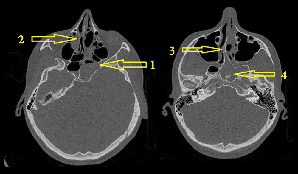 Sphenoid sinusitis deals neurological symptoms