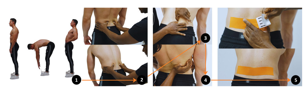 The Dynamic Arthro-Myofascial Translation Test (DAMT-test). This figure displays the full DAMT-test procedure of L3 as an example of obtaining the trigger and tape direction for trunk flexion. Test: (1) First the patient underwent a baseline test to obtain the flexion and extension trunk range of motion and level of pain (pain NRS). Subsequently, the most painful spinal movement direction (highest pain NRS score) was used as a reference test to test the effect of displacing the skin and underlying fasciae (SKD) on the range of motion and level of pain. (2) The reference test was performed with ongoing mediolateral SKD to the left and right. The 3 tests (reference test including no SKD or left SKD or right SKD) were compared by the patient in choosing the best condition as the so-called ‘positive’ direction. (3) Trigger: The positive direction was the direction of the triggers, which started with softening the superficial fascia toward the deeper myofascia. (4) After softening the tissues, the tested spinal segment (eg, L3) was mobilized in the direction of the positive SKD test and in the directional preference. (5) Tape: Subsequently, the elastic tape was applied by rubbing the skin and fascia in the mediolateral positive direction. After the full procedure (steps 1 to 5), the steps were repeated for the next location (eg, from 1st step L3 to 2nd step S2) till the patient could move with an acceptable level of pain so the patient was able to perform the prescribed training. (Represented photos are from the 4xT book with permission of the author Karl Noten [24]).