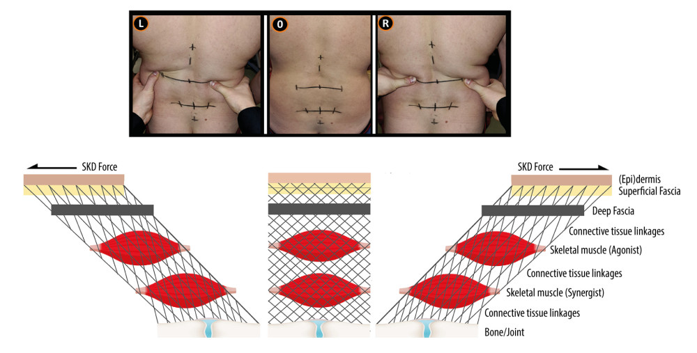 Skin displacement. This figure illustrates the rationale underlying the effects of skin displacement (SKD) used in the Dynamic ArthroMyofascial Translation® test. The SKD is expected to generate force that is transmitted via connective tissue linkages to underlying structures, including fasciae, muscles, and joints/bones, and change their relative position, potentially affecting the firing behavior of mechanosensory receptors. The effects of the SKD are expected to vary depending on the location and direction of the SKD. SKD – skin displacement; L – left SKD; R – right SKD; 0 – neutral. Image used with permission from van Amstel, Jaspers, and Pool-Goudzwaard.
