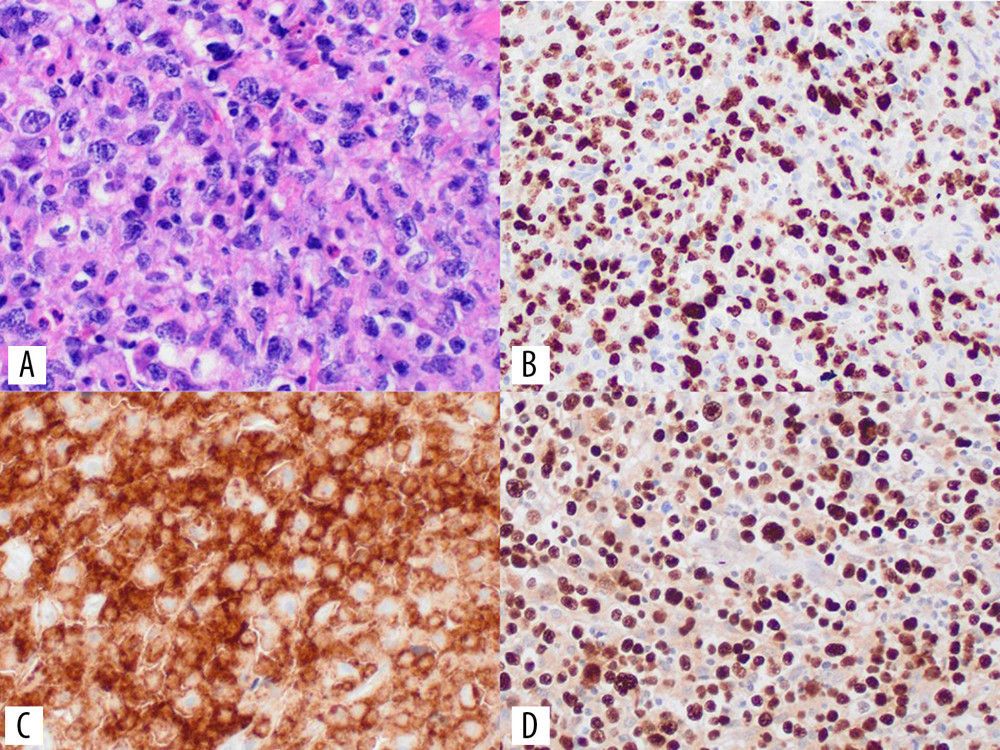 Biopsy from left nasal cavity and bilateral maxillary sinus showing diffuse involvement by an aggressive lymphoid neoplasm, with atypical lymphocytes of varying sizes exhibiting prominent nuclear irregularity, apoptosis, and scattered mitotic figures admixed with eosinophils, macrophages, and plasma cells (A: H&E stain, 200× magnification). The tumor shows a very high proliferative index of Ki-67: ~80% (B). The neoplastic cells from the nasal cavity mass are diffusely positive by CD56 stain (C) and EBER in-situ hybridization (D). Of note, testing of the nasal cavity mass was performed at New York-Presbyterian Brooklyn Methodist Hospital, utilizing brownish-red EBER chromogenic staining. H&E – hematoxylin and eosin; EBER – EBV-encoded small RNA.