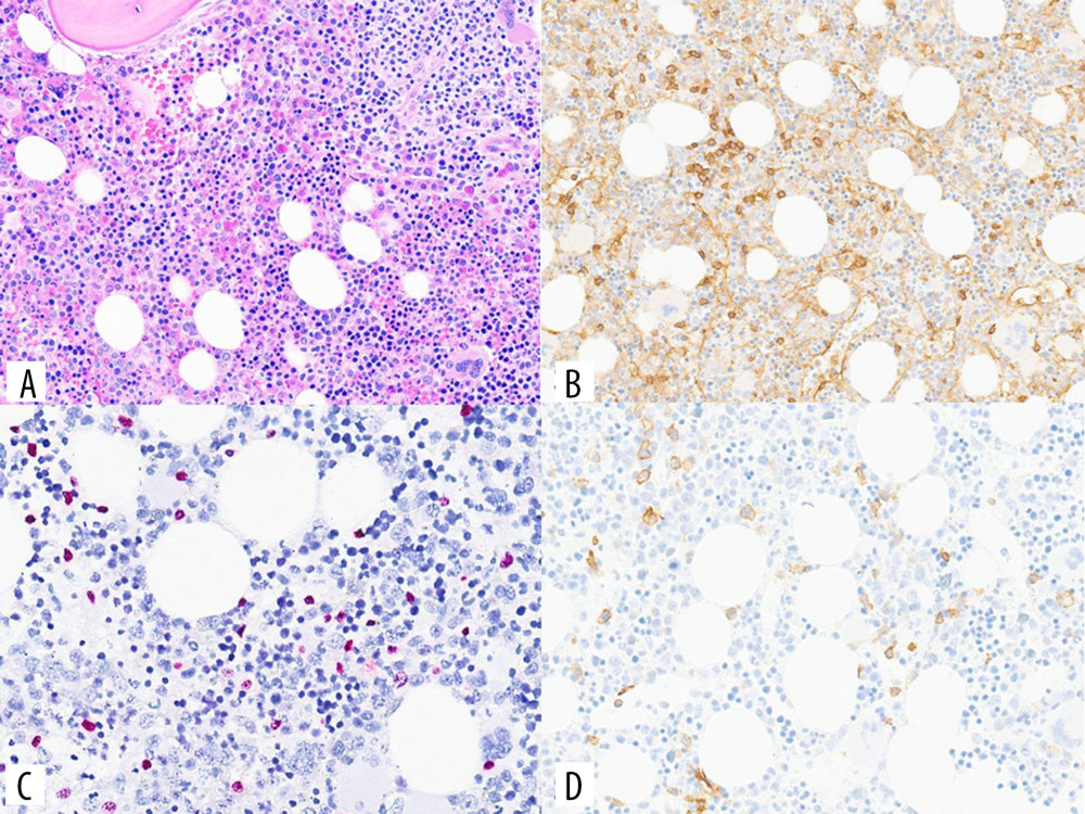 Subsequent bone marrow biopsy shows subtle involvement by the same lymphoid neoplasm, consisting of atypical lymphocytes of varying sizes with pale to clear cytoplasm, with small interstitial lymphoid aggregates and hypercellularity for the patient’s age (A: H&E stain, 100X magnification). The tumor cells are highlighted by positive CD4 (B) and CD56 (D) stain. A positive EBER in-situ hybridization further confirmed the subtle bone marrow involvement by natural killer-T-cell lymphoma (C: 3,3’-DAB chromogen stain). Of note, testing of the bone marrow sample was performed at New York-Presbyterian Weill-Cornell Medical Center utilizing magenta-red chromogenic staining. H&E – hematoxylin and eosin; DAB – diaminobenzidine; EBER – EBV-encoded small RNA.