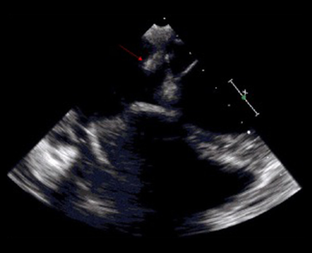 A trans-esophageal echocardiogram showed a bioprosthetic valve in the tricuspid position with thickened leaflets and 1.7×1-cm mobile vegetation (arrow).
