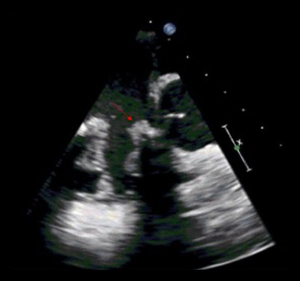 Transesophageal echocardiography was performed and the size of the vegetation on the valve was found to be 0.68×0.87 cm (arrow).