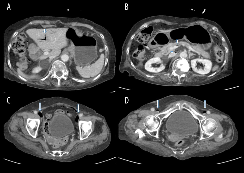 (A) Axial enhanced abdominal computed tomography (CT) at the level of the hepatic hilum shows portal venous gas (arrow). (B) Axial CT image through the kidneys shows gas in the splanchnic veins. Also noted are small foci of gas in the inferior vena cava (arrowhead) and main portal vein (arrow). Axial CT images show venous air (arrows) in (C) both external iliac veins and (D) femoral veins.