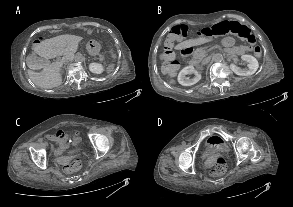 (A–D) Computed tomography scans show complete resolution of gas throughout the portal system to femoral veins.