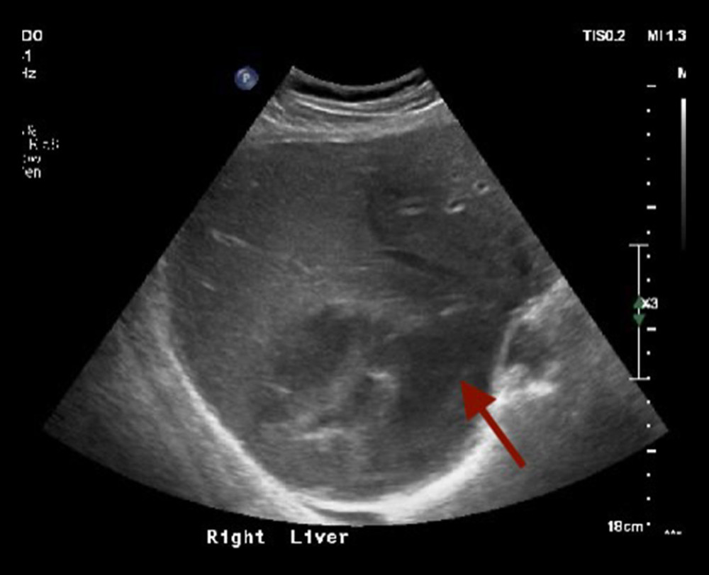 Ultrasound image of a Klebsiella liver abscess prior to treatment. This test was performed on the patient’s initial day of presentation. The red arrow indicates an area of the abscess.
