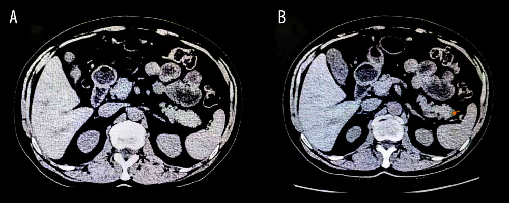 (A, B) The computed tomography results showed that the shape and density of the pancreas were standard and it had a full tail. The suspicious lesion is indicated by the arrow.