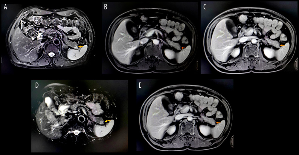 Magnetic resonance imaging (MRI) results show that the morphology of the pancreas is normal. However, the tail of the pancreas shows irregular long T1 and long T2 signals with a maximum diameter of 1.4 cm, well-defined boundaries, and a continuous enhancement of the arterial phase. Positron emission tomography-computed tomography is recommended because MRI cannot identify the nature of the lesion. The suspicious lesion is indicated by the arrow. (A) T2; (B) T1 early arterial phase; (C) T1 extended phase; (D) T2 fat suppression phase; and (E) T1 late arterial phase.