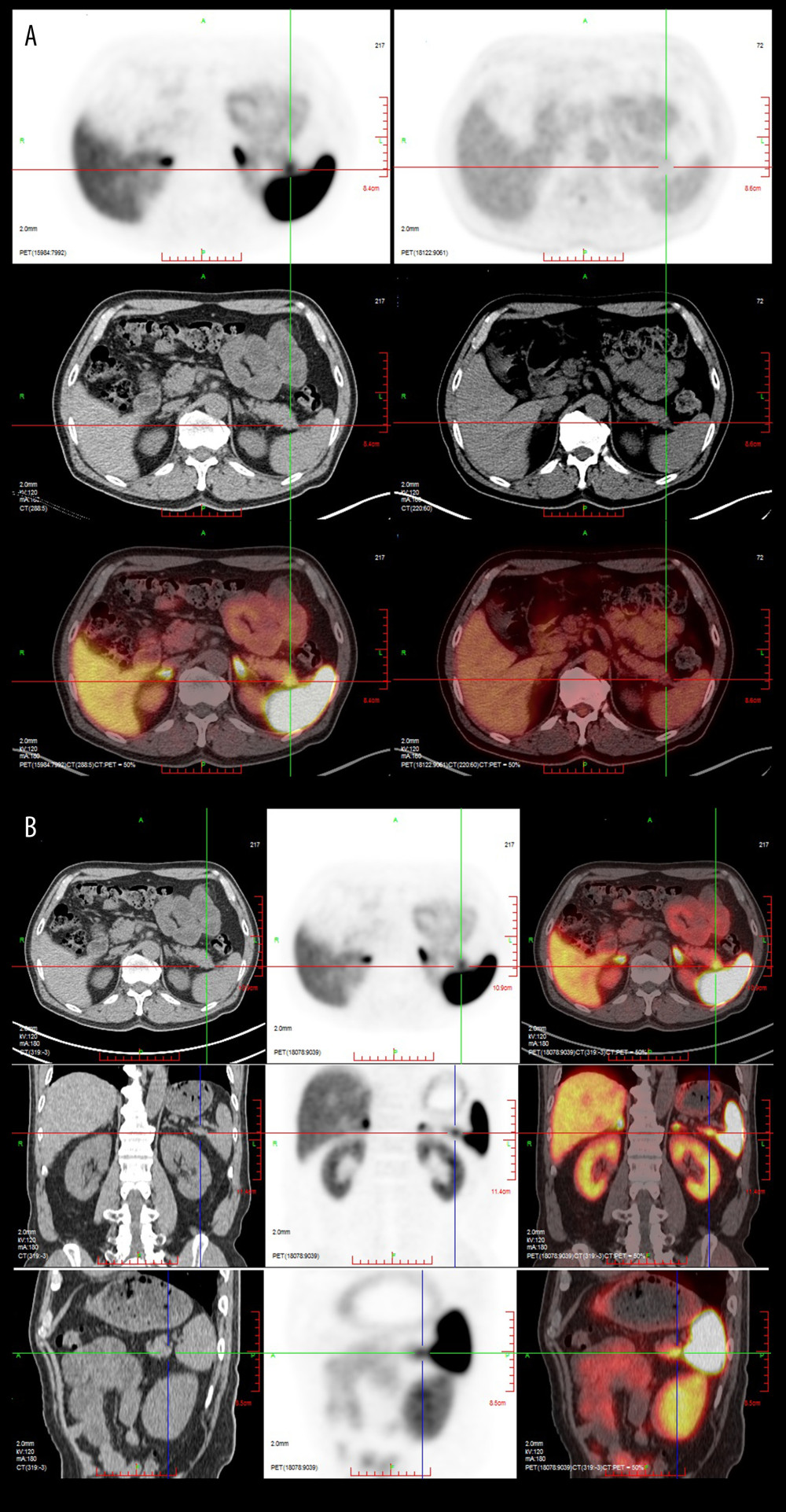 (A) Fluorodeoxyglucose positron emission tomography-computed tomography (PET-CT) results revealed that there was a slightly low-density shadow lesion in the tail of the pancreas and no obvious metabolism, and benign or low-grade malignant lesions were considered. (B) Ga-68 dotatate PET-CT results demonstrated that the space-occupying lesions in the pancreatic tail were likely neuroendocrine tumors.
