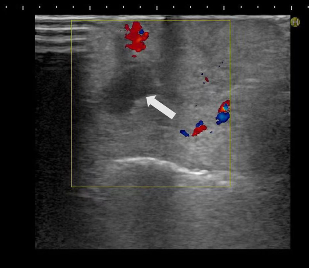 Endoscopic ultrasound showed a hypoechoic nodule in the tail of the pancreas with a clear border and no clear blood flow signal on color Doppler flow imaging.