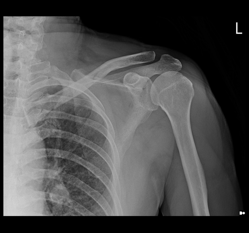 Plain anteroposterior radiography of the shoulder revealing a linear midshaft clavicle fracture without obvious widening of the acromioclavicular joint space or elevation of the lateral end of the clavicle. Image was taken in the emergency department.