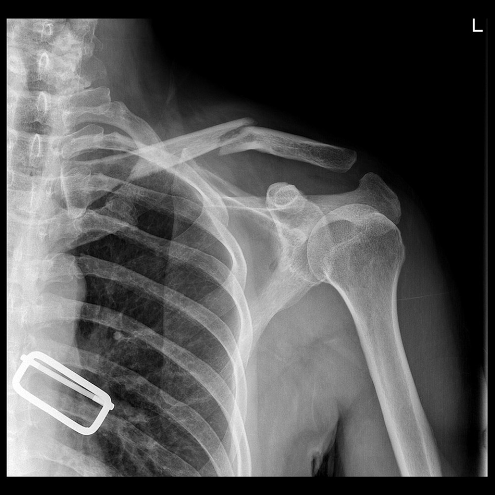 The followup radiograph taken in the outpatient department 3 days after the emergency department visit revealed an inverted V-pattern displaced midshaft clavicle fracture.