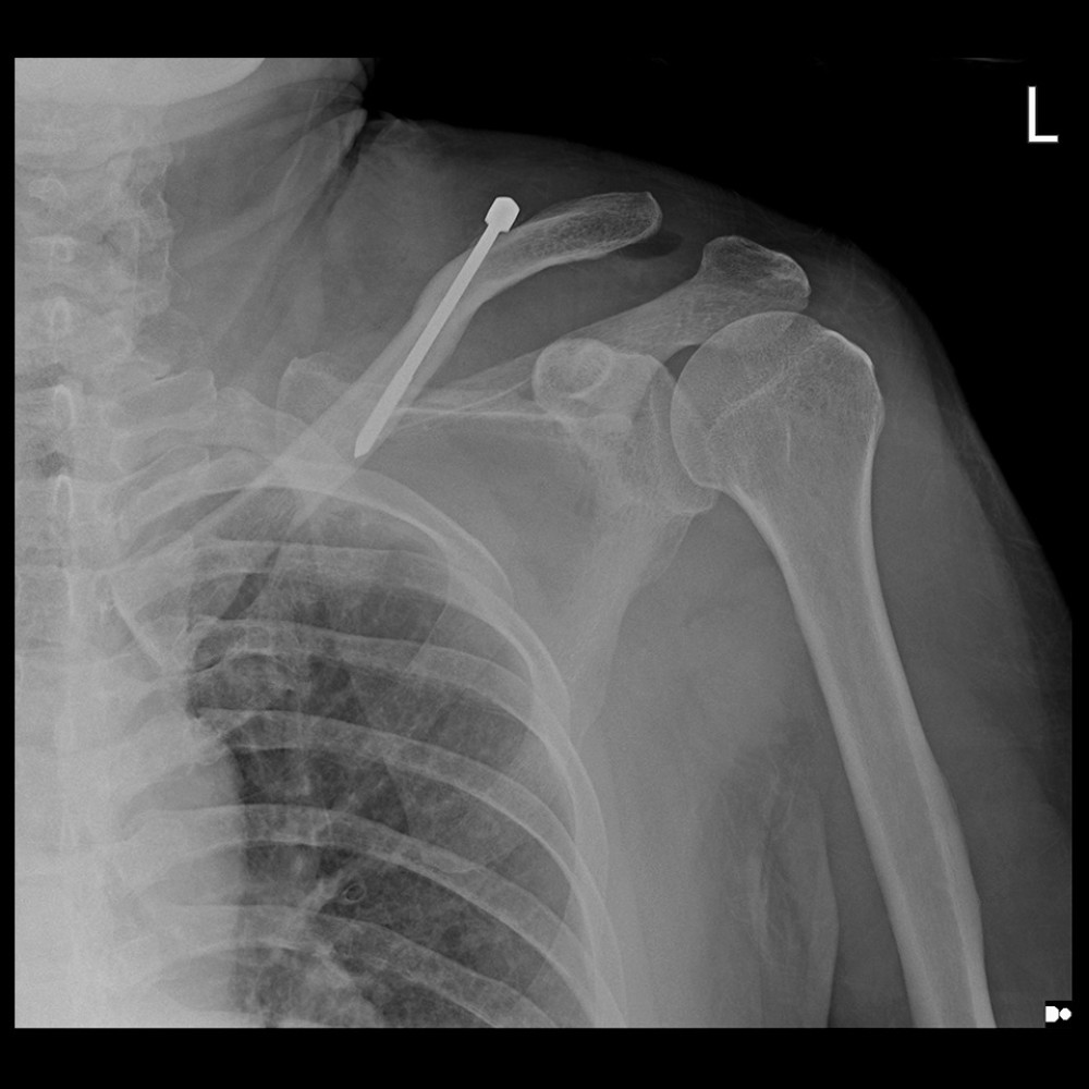 The immediate postoperative shoulder radiograph revealed a significant displacement of the acromioclavicular joint (ACJ) after open reduction and internal fixation with a Knowles pin for clavicle fracture. Type V ACJ dislocation was diagnosed according to the Rockwood classification.