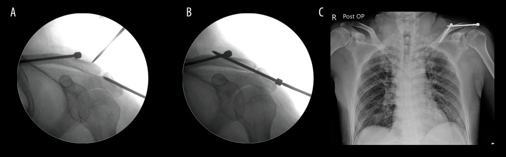 (A) With the aid of a C-arm image intensifier, a closed reduction was made by using a Kirschner wire to push the clavicle into the anatomical position. (B) The Knowles pin from the acromion tip that crossed the acromioclavicular joint (ACJ) to the distal clavicle achieved cortical anchoring over the posterior aspect of the distal clavicle. The ACJ space was maintained by the lag screw technique when using the Knowles pin fixation method. (C) Postoperative radiograph showing a good reduction in ACJ dislocation treated with closed reduction with percutaneous Knowles pin fixation.