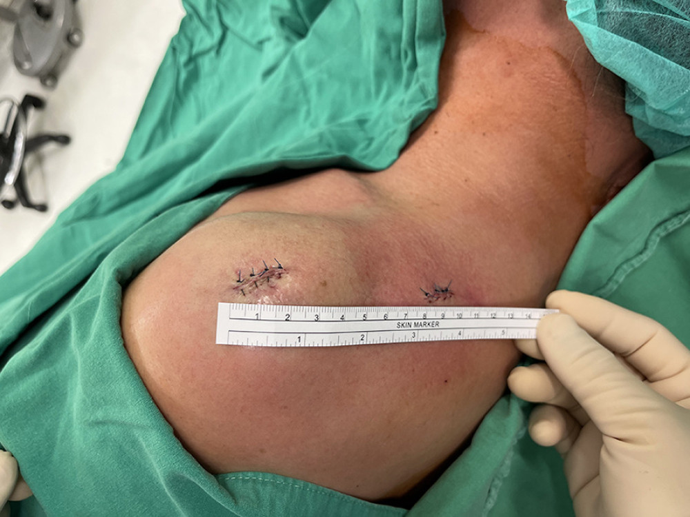 The 2 Knowles pins were removed under local anesthesia in outpatient surgery. The surgical wound is small when a Knowles pin is used.
