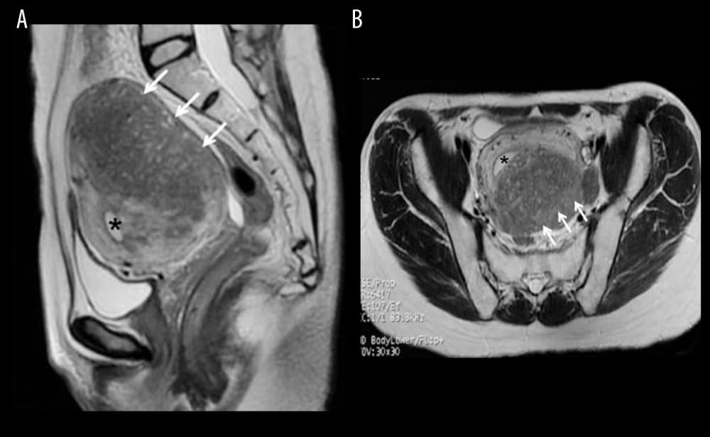 Plain T2-weighted magnetic resonance images prior to pregnancy show adenomyotic foci (arrows) in diffuse thickening of the muscle layer of the posterior wall. The endometrium (*) is seen as a T2 high-intensity area in the inner part of the uterus. (A) Sagittal view; (B) horizontal view.