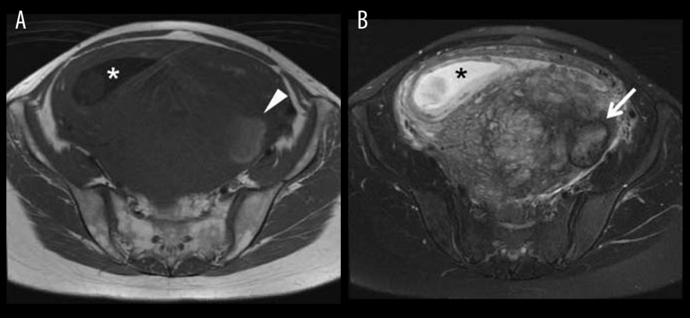 Plain magnetic resonance images at 13 weeks of gestation. Hemorrhagic foci inside the adenomyosis present as hyperintensities on T1-weighted image (A, arrowhead) and as heterogeneous hyperintensities with a hypointense rim on fat-suppressed T2-weighted image (B, arrow). Gestational sac (*) is in the uterus.