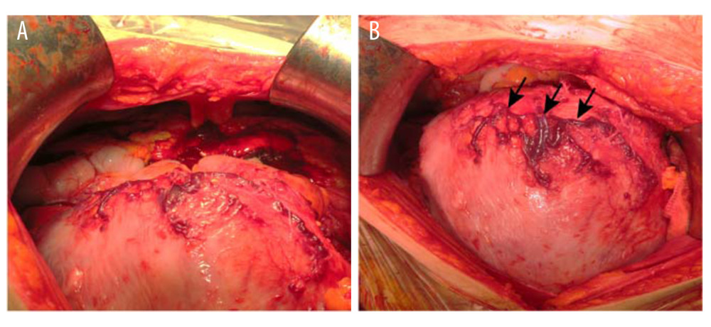 Intraoperative findings. (A) The blood pooled in the abdominal cavity reaches the upper abdomen. (B) Abnormal blood vessels (arrows) are observed on the uterine surface.