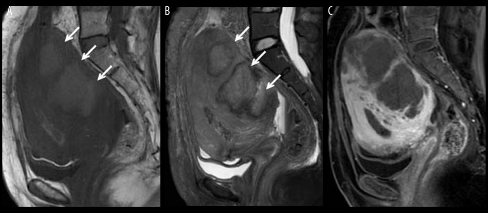 Contrast-enhanced magnetic resonance imaging 8 days after caesarean delivery shows an extensive hemorrhagic infarction in the adenomyosis in the posterior wall. Both T1-weighted (A) and T2-weighted imaging (B) show high-intensity signals (arrows), and contrast defects are shown with a gadolinium contrast agent (C).