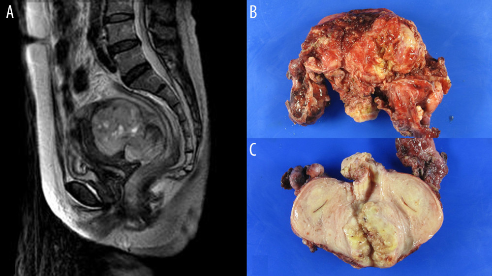 (A) Magnetic resonance imaging revealed an exophytic, 8.1×6.5 cm, solid mass at the uterine cervix, which has internal necrosis and hemorrhage. (B) A posterior view of the hysterectomy specimen shows a rupture of the uterine solid mass. (C) A transverse cut surface of the uterus shows that the solid mass is centered on the myometrium and does not invade the uterine cavity. It is yellow in color and has internal necrosis and hemorrhage.