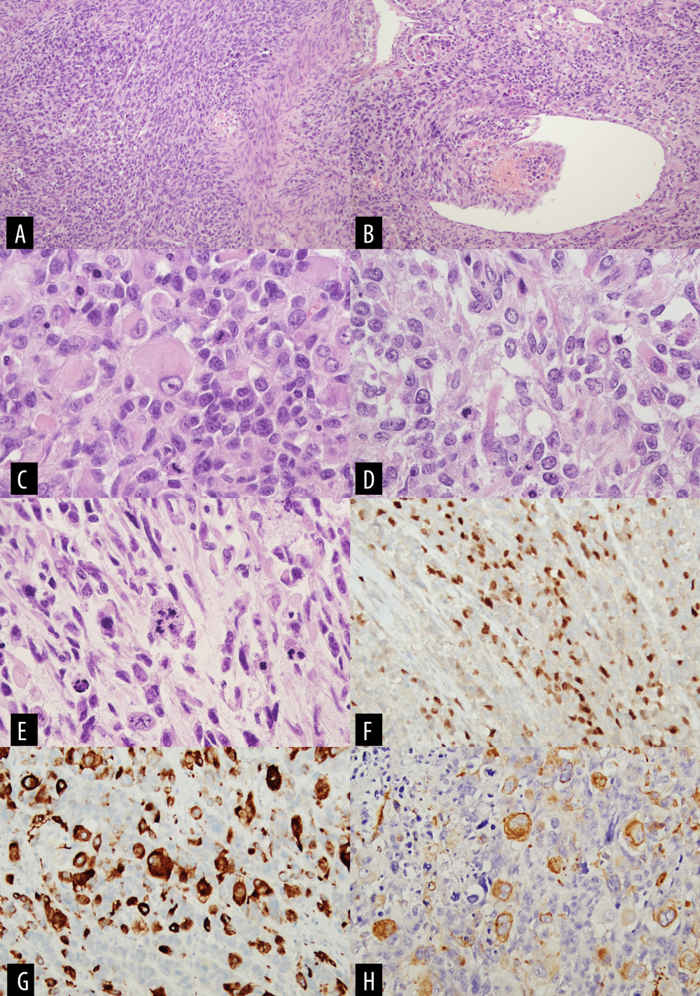 Microscopic findings. (A) On low-power magnification, spindle cells are focally arranged in interlacing bundles (hematoxylin and eosin, ×100). (B) Intravascular invasion and lymphovascular tumor emboli are observed (hematoxylin and eosin, ×100). (C) Rhabdoid cells, which have central eosinophilic inclusions and large eccentric nuclei with prominent nucleoli, are admixed with epithelioid cells (hematoxylin and eosin, ×400). (D) Elongated cells with abundant eosinophilic cytoplasm, called strap cells, seldom appear (hematoxylin and eosin, ×400). (E) Atypical mitosis is noted among spindle cells (hematoxylin and eosin, ×400). (F) Epithelioid and rhabdoid cells are focally immunoreactive for myogenin antibodies (myogenin immunohistochemistry, ×100). (G) Desmin is expressed in epithelioid and rhabdoid cells but not in spindle cells (desmin immunohistochemistry, ×200). (H) The cytoplasm of rhabdoid cells react with antibodies against smooth muscle actin (smooth muscle actin immunohistochemistry ×200).