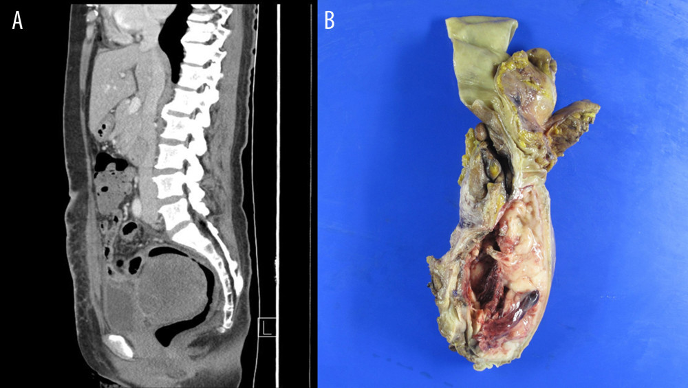 (A) A new 8.6×7.7 cm mass with heterogeneity and rim enhancement on computed tomography 3 weeks after the hysterectomy. The mass abutted the recto-sigmoid colon and urinary bladder. (B) The solid mass was tightly adhered to the recto-sigmoid colon (right) and urinary bladder (left) on the pelvic exenteration specimen. It collapsed because it had cystic change due to necrosis. Hemorrhage of the mass was also observed.