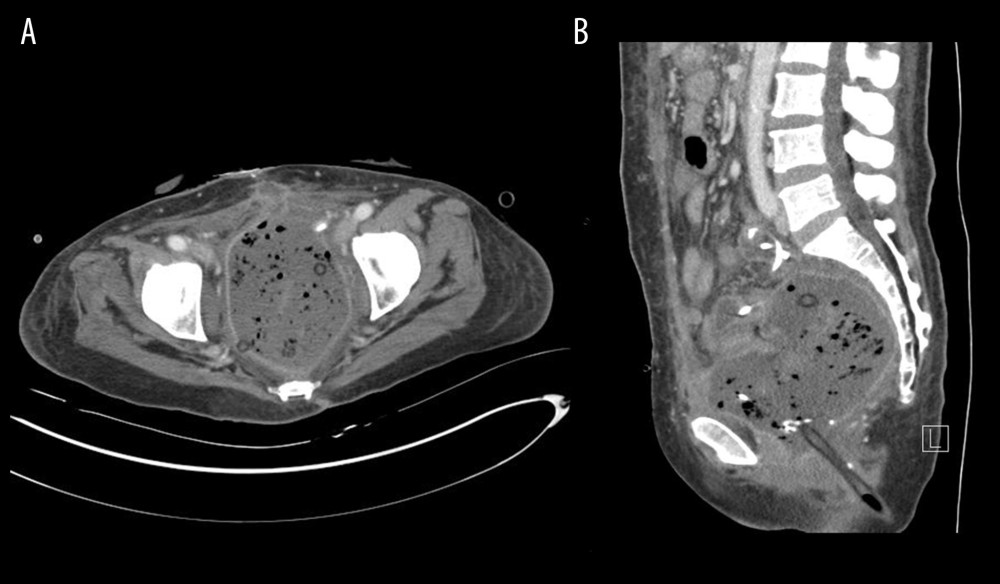 (A, B) Two weeks after 2 the pelvic exenteration, a 13.9×13.0 cm lesion was noted on computed tomography. It was connected to the fistula of the subcutaneous layer of the incision site [A] and was located within the abscess cavity [B].