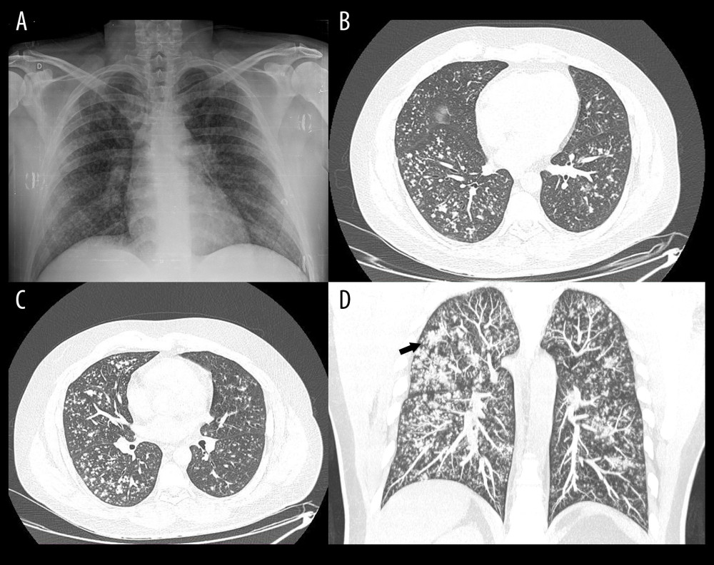 Imaging studies: (A) Chest X-ray at admission with diffusely distributed nodules in both lungs; (B–D) Chest CT 2 days before admission showing small 5–10 mm nodules diffusely distributed, sparing subpleural spaces (centrilobular pattern), some with ramifications that indicate airway involvement, and small consolidations in the vascular trajectory, particularly in the upper right lobe (arrow). CT – computed tomography.