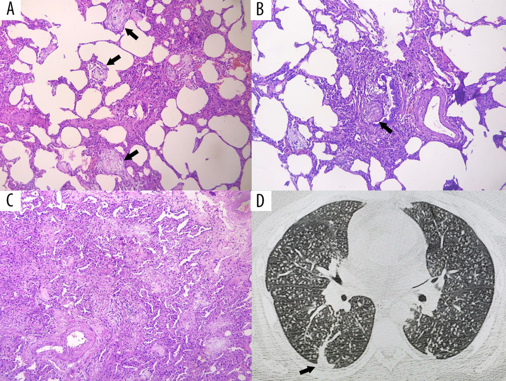 Histopathological findings and CT image: (A) Histological sections showing lung tissue with light-colored interstitial nodules of fibroblast proliferation immersed in an extracellular edematous matrix, some of them occupying the alveolar lumen (arrows); (B) Injury to the epithelium of the terminal bronchiole with interstitial fibroblastic proliferation nodule partially occluding its lumen (plugs) (arrow); (C) Multiple light-colored fibroblastic nodules distending the septal interstitium and occupying the air spaces with atelectasis of adjacent pulmonary tissue; (D) Tomographic image obtained 2 weeks before the biopsy showing multiple centrilobular pulmonary nodules and a dense triangular elongated band based on parietal pleura assigned to atelectasis (arrow). The histological findings characterize an organizing pneumonia pattern; no infectious organisms or viral cytopathic changes were identified. CT – computed tomography.
