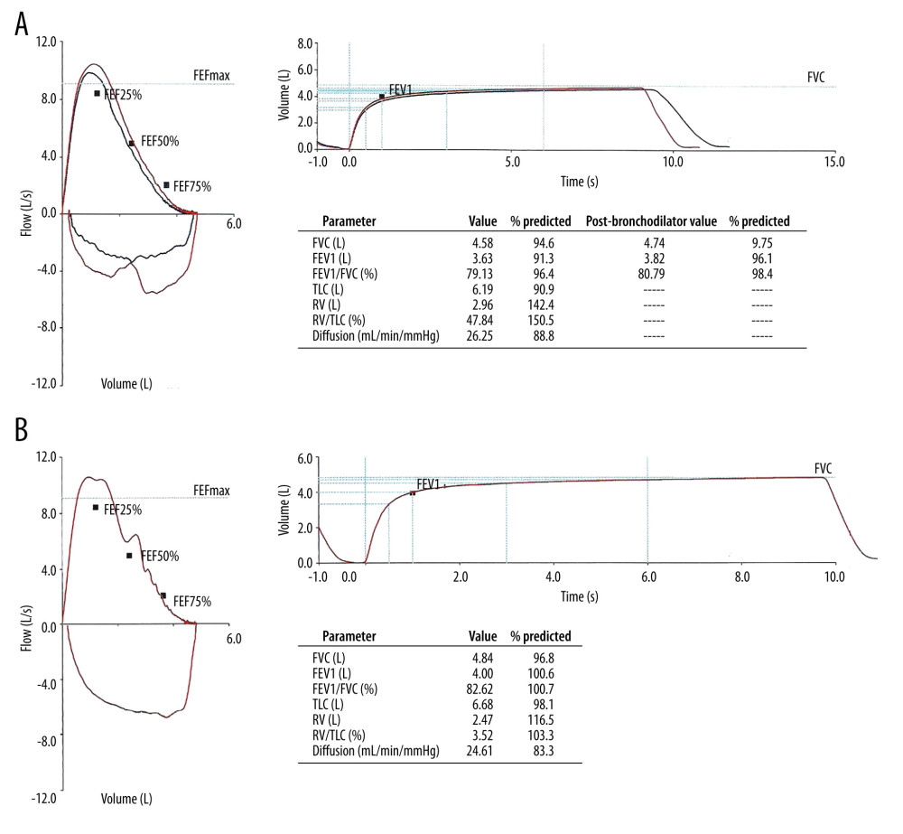 Pulmonary function tests: (A) Parameters 20 days after discharge showing normal values of dynamic and static volumes of capacities, a negative bronchodilator test (red in the charts), an increase in residual volume (RV) absolute and relative to total lung capacity (TLC), suggesting airway obstruction not observed in spirometry, and a normal carbon monoxide (CO) diffusing capacity; (B) Prebronchodilator values 7 months after discharge with normalization of RV and a normal CO diffusing capacity. FVC – forced vital capacity; FEV1 – forced expiratory volume in 1 second.