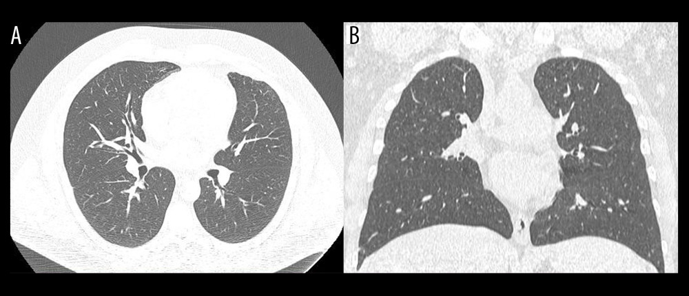 Late chest CT: (A, B) CT 9 months after discharge showing disappearance of the lesions previously described. CT – computed tomography.