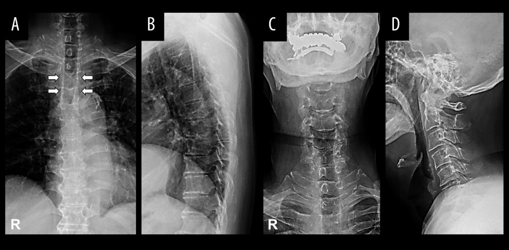 Preoperative radiographs showing osteolytic lesion at T3 and T4. (A) A posteroanterior radiograph of thoracic spine with bilateral winking owl sign at T3 and T4 (white arrows). (B) A lateral radiograph of thoracic spine. (C) A posteroanterior radiograph of cervical spine. (D) A lateral radiograph of cervical spine.