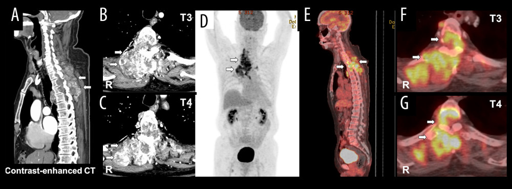 Preoperative contrast-enhanced computed tomography (CT) images (A–C) and positron emission tomography (PET) images (D–G) of the spine indicating multiple mass lesion at C7–T5 level. (A) A right-sagittal CT image showing vertebral body osteolysis and partly enhanced mass lesion at T3 and T4. (B, C) Axial CT images showing partly enhanced mass lesion invading rib, vertebrae, and spinal canal at T3 (B) and T4 (C). (D) A coronal PET image showing 18-labeled fluorodeoxyglucose accumulation. (E) A sagittal PET image showing 18-labeled fluorodeoxyglucose accumulation. (F, G) Axial PET images showing 18-labeled fluorodeoxyglucose accumulation at T3 (F) and T4 (G). White arrows indicate the tumor.