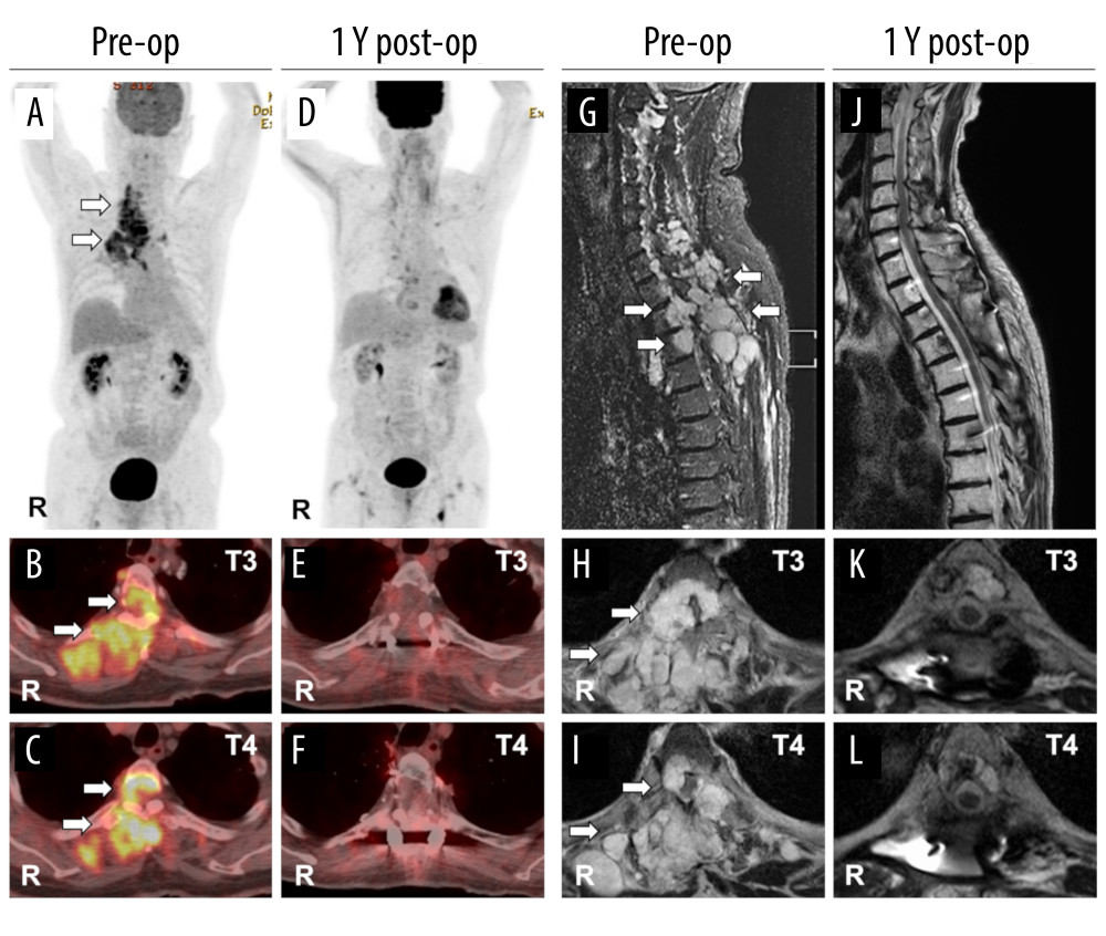 Comparison of preoperative and one-year postoperative images showing no local recurrence of the tumor. (A–C) Preoperative positron emission tomography (PET) images of coronal (A) and axial at T3 (B) and T4 (C) sections. (D–F). One-year postoperative PET images of coronal (D) and axial at T3 (E) and T4 (F) sections. (G–I) Preoperative T2-weighted magnetic resonance images (MRI) of sagittal (G) and axial at T3 (H) and T4 (I) sections. One-year postoperative T2-weighted MRI of sagittal (J) and axial at T3 (K) and T4 (L) sections. White arrows indicate the tumor.